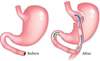 Roux-Y-Magenbypass bei Adipositas