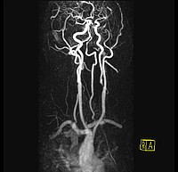 Kernspintomographische Darstellung der Hirnversorgung