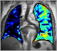 o2-verstärkte MRT zur Darstellung von Ventilation, Diffusion, Perfusion