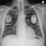 Optimizer IV und 1-Kammer-ICD