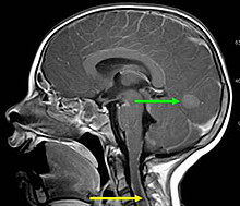 Neuroblastom