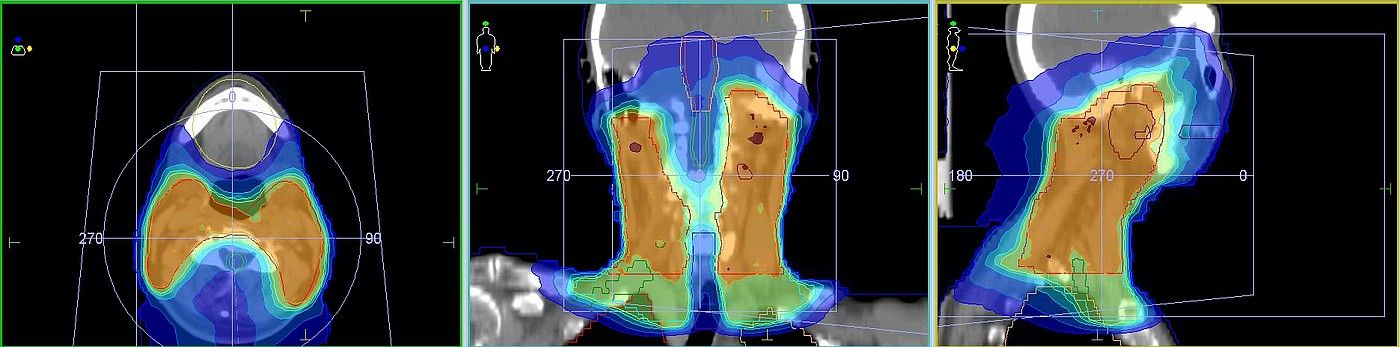 Exemplarische Dosisverteilung einer Hals/Kopf-Bestrahlung