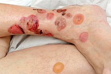 Bullöses Pemphigoid 