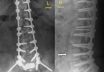 Schrauben-Stab-System