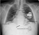 CRT-Gerät bei Herzrhytmusstörungen