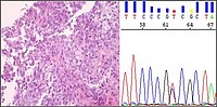 Bronchiales Adenokarzinom mit EGFR-Mutation