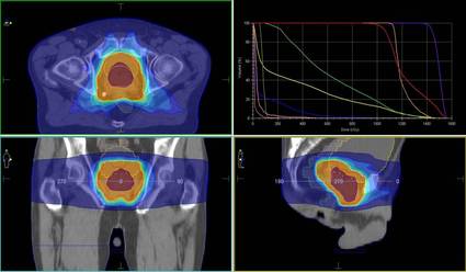 Exemplarische Dosisverteilung bei der Prostatabestrahlung mit zugehörigem Dosis-Volumen-Histogramm